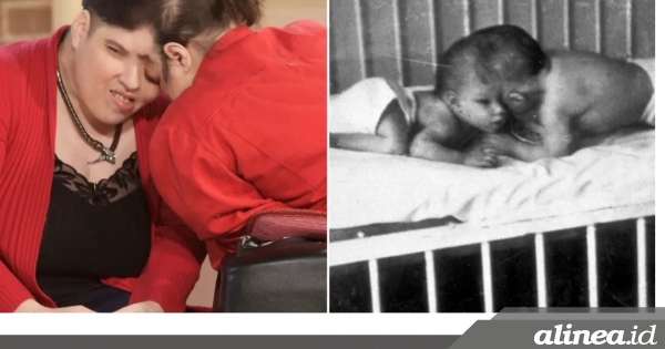 Lori dan George Schappell, kembar siam tertua di dunia tutup&nbsp;usia